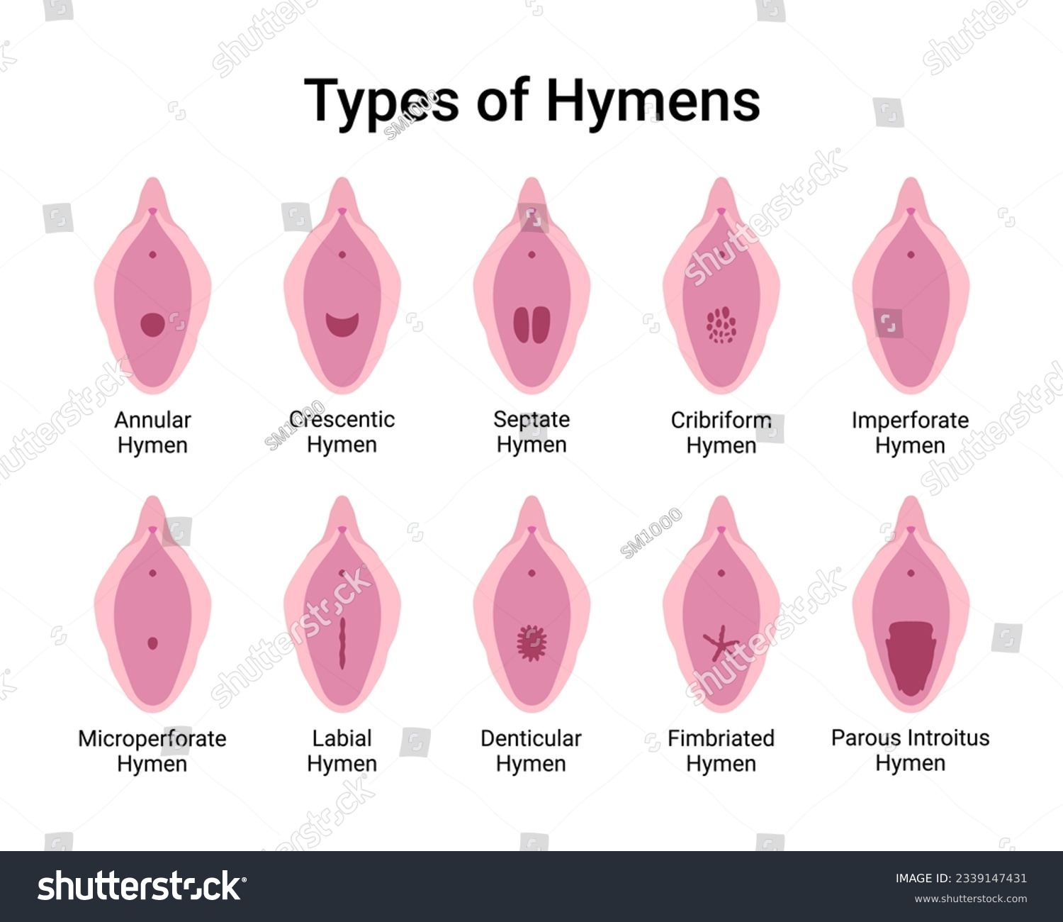 amy scott recommends picture of hymen pic
