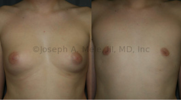 ally williamson add flat chest puffy nipples photo