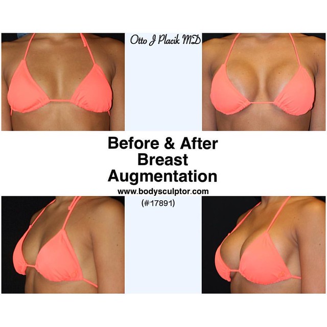 althea lantican recommends What Do 34c Breast Look Like