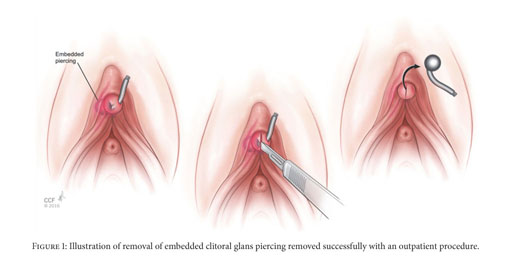 david goll recommends clit piercing does it hurt pic