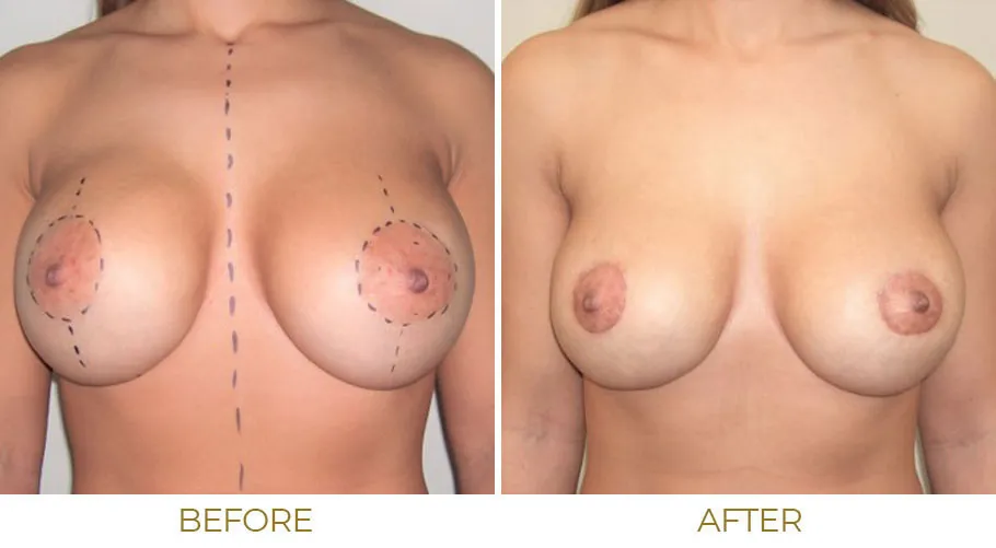 daniel labranche recommends women with small areolas pic